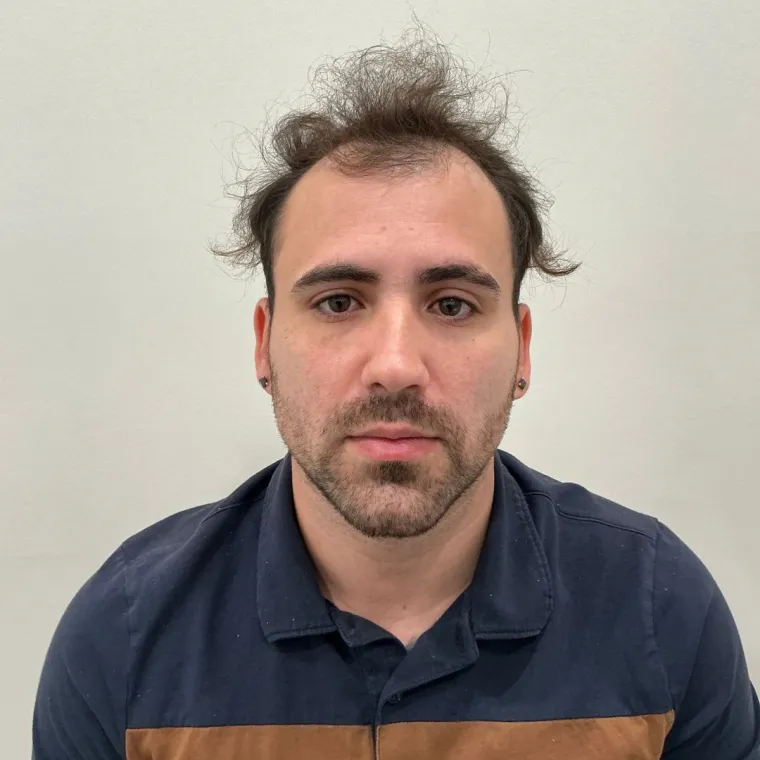 Front and mid-scalp restoration, before, front view, Hair Transplant Design Tampa