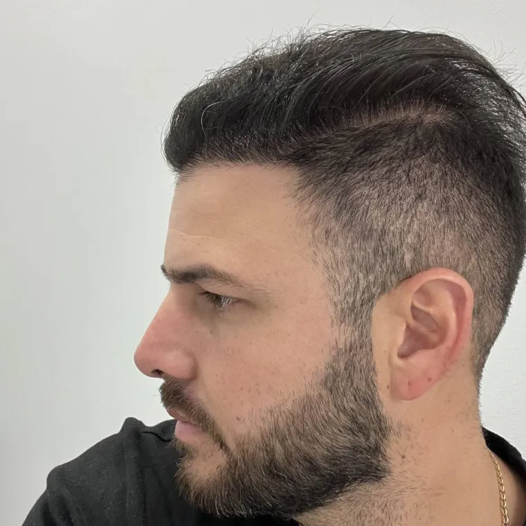 Super full hair restoration, after, profile, Hair Transplant Design Tampa