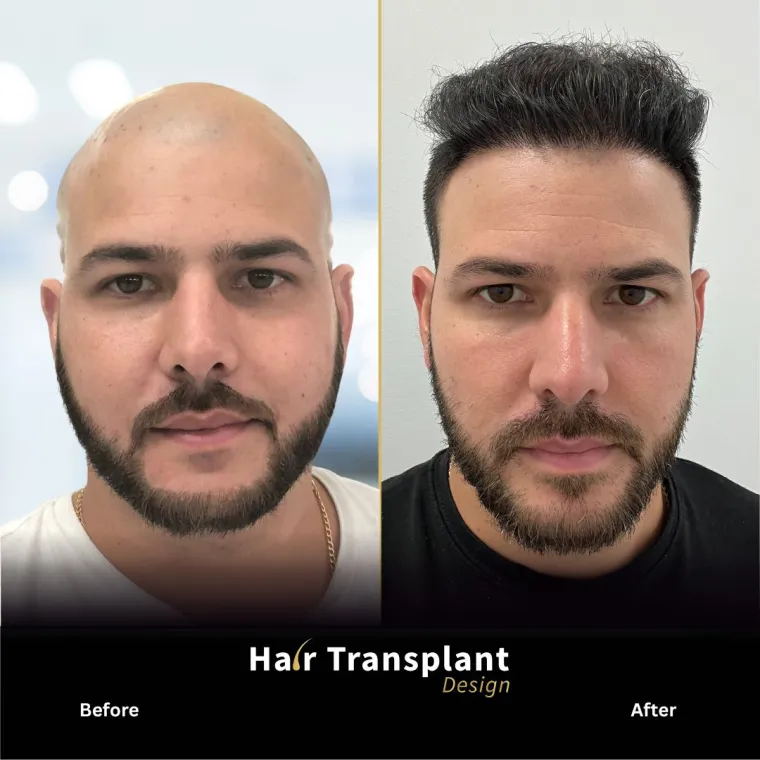 Super full hair restoration, before and after, Hair Transplant Design Tampa