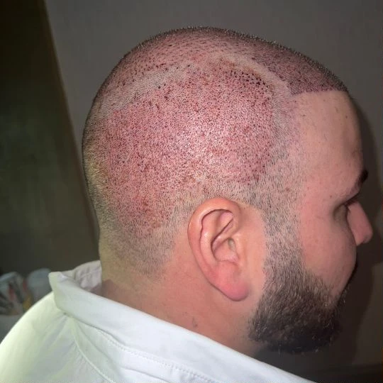 Super full hair restoration, the first days, healing, Hair Transplant Design Tampa