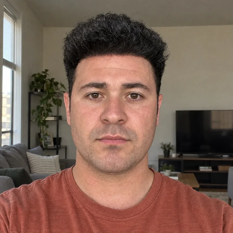 Receding Temples Rebuilt, after, everyday, Hair Transplant Design Tampa