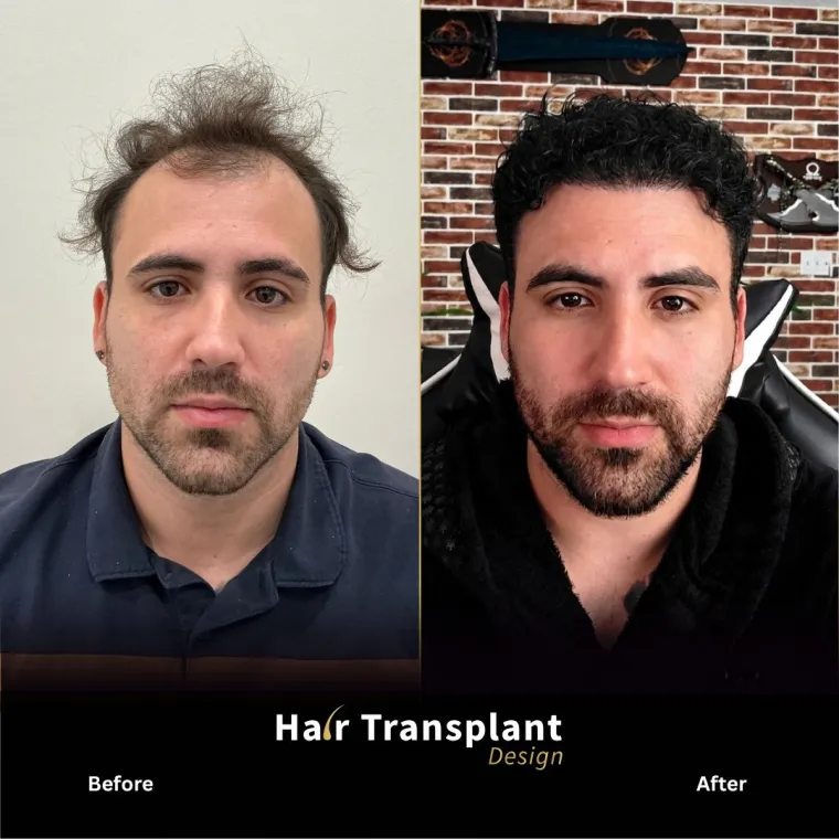 Restauración frontal y de zona media, antes y después, Hair Transplant Design Tampa