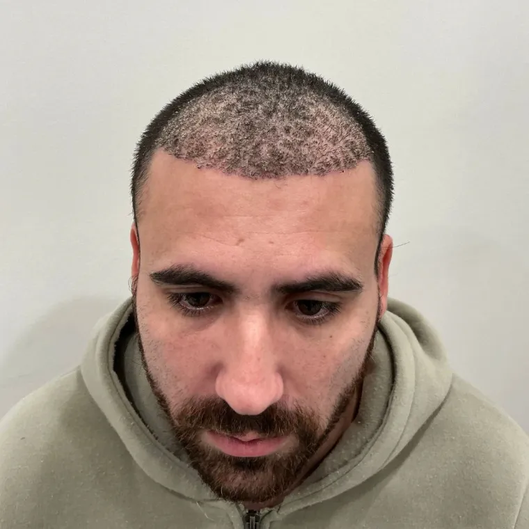 Restauración frontal y de zona media, los primeros días, cicatrización, Hair Transplant Design Tampa