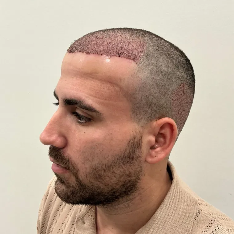 Restauración frontal y de zona media, el día de la cirugía, perfil, Hair Transplant Design Tampa