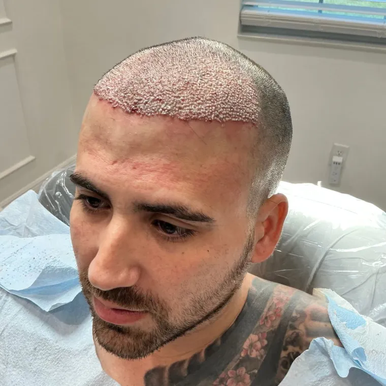 Restauración frontal y de zona media, el día de la cirugía, Hair Transplant Design Tampa