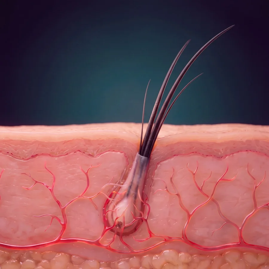 Ilustración médica: en el mes doce el folículo trasplantado está completamente integrado, con pelos de largo completo