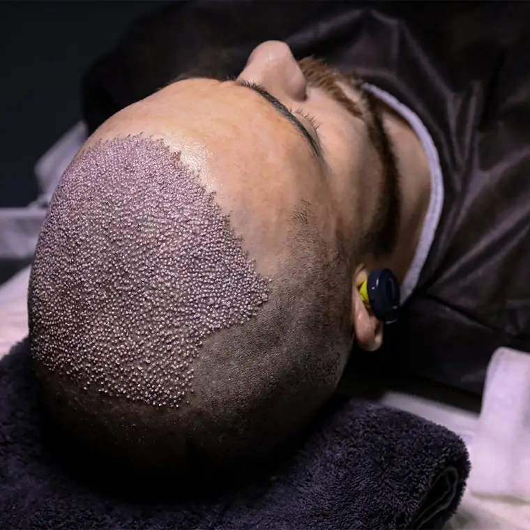 Injertos FUE recién implantados cubriendo la zona diseñada