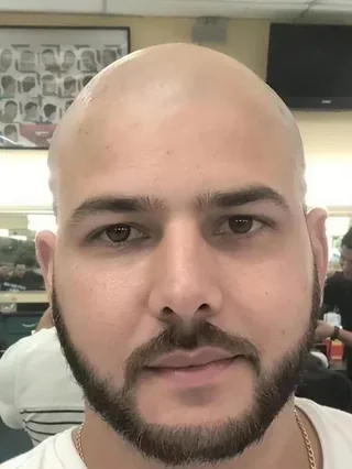 Raúl antes de su trasplante capilar, con la cabeza rapada y pérdida de pelo avanzada
