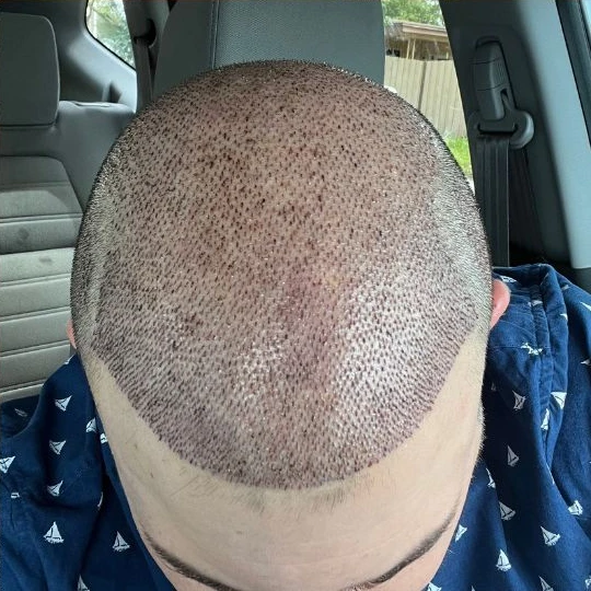 Restauración capilar súper completa, los primeros días, asentándose, Hair Transplant Design Tampa