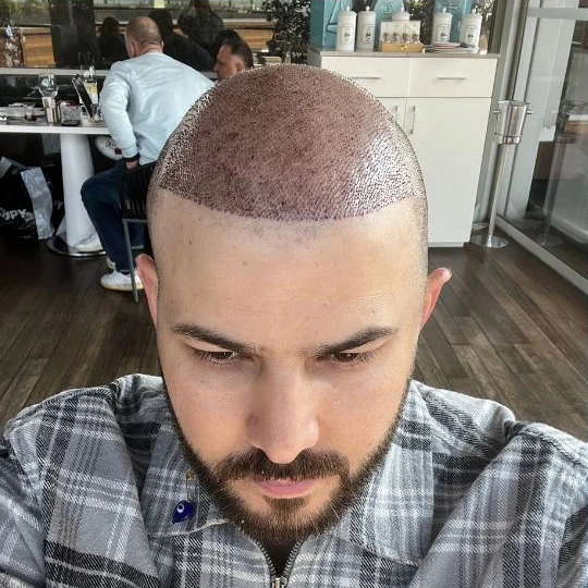 Restauración capilar súper completa, los primeros días, desde arriba, Hair Transplant Design Tampa