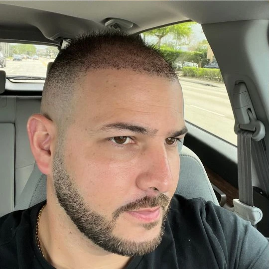 Restauración capilar súper completa, en crecimiento, ganando densidad, Hair Transplant Design Tampa