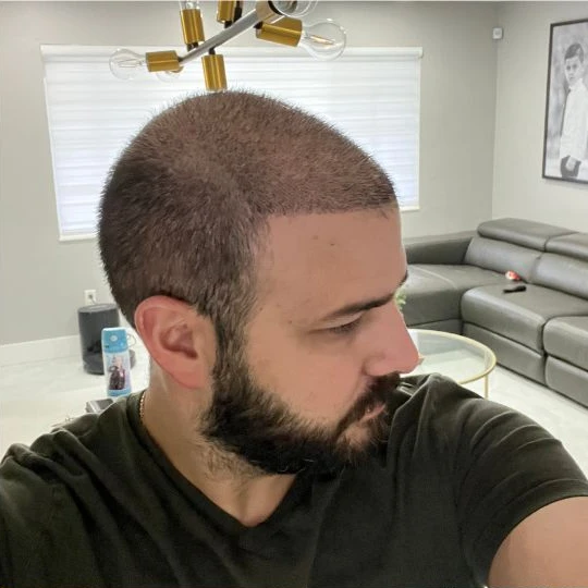 Restauración capilar súper completa, en crecimiento, perfil, Hair Transplant Design Tampa