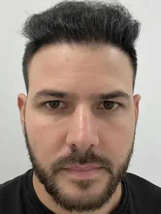 Raúl después de 5,500 injertos en Hair Transplant Design: línea frontal completa y densidad