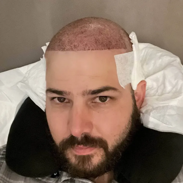 Restauración capilar súper completa, el día de la cirugía, Hair Transplant Design Tampa