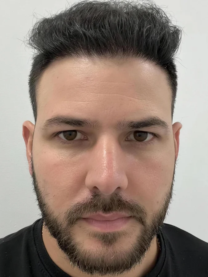 Raúl after 5,500 grafts at Hair Transplant Design: full hairline and density