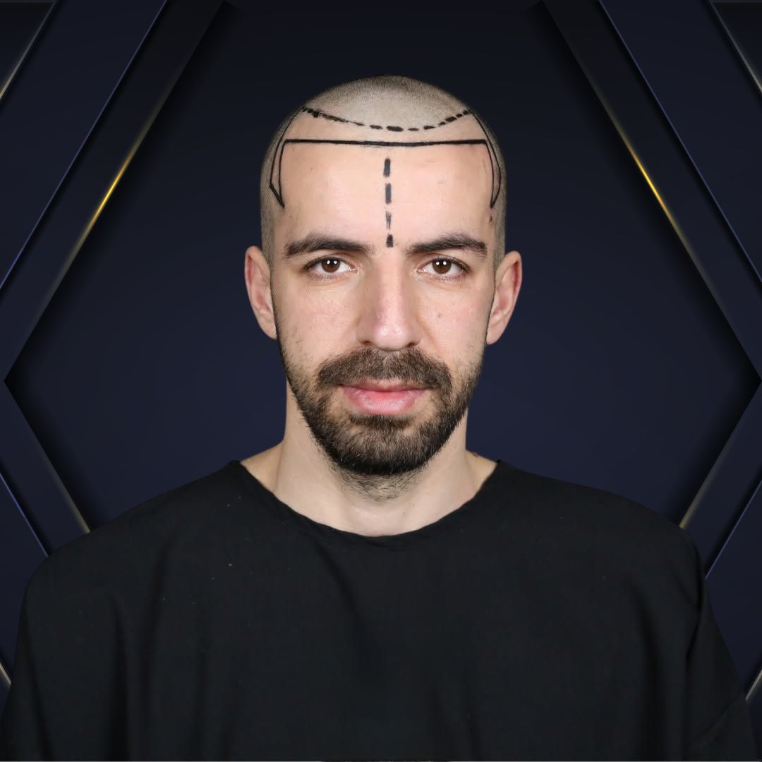 Every Patient Deserves a Custom Design - Hair Transplant Design in Tampa