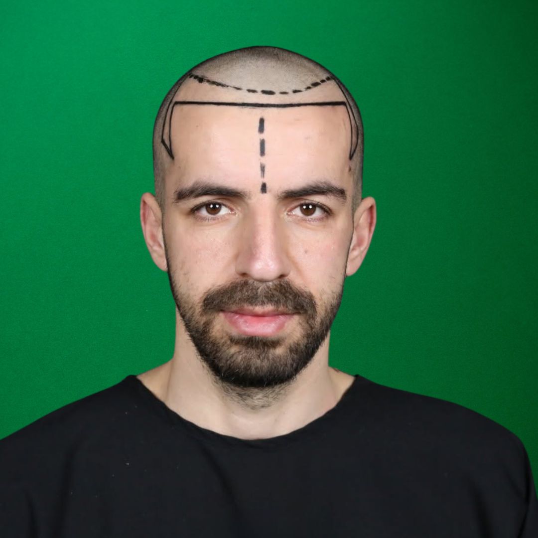 Every Patient Deserves a Custom Design - Hair Transplant Design in Tampa - Before 2
