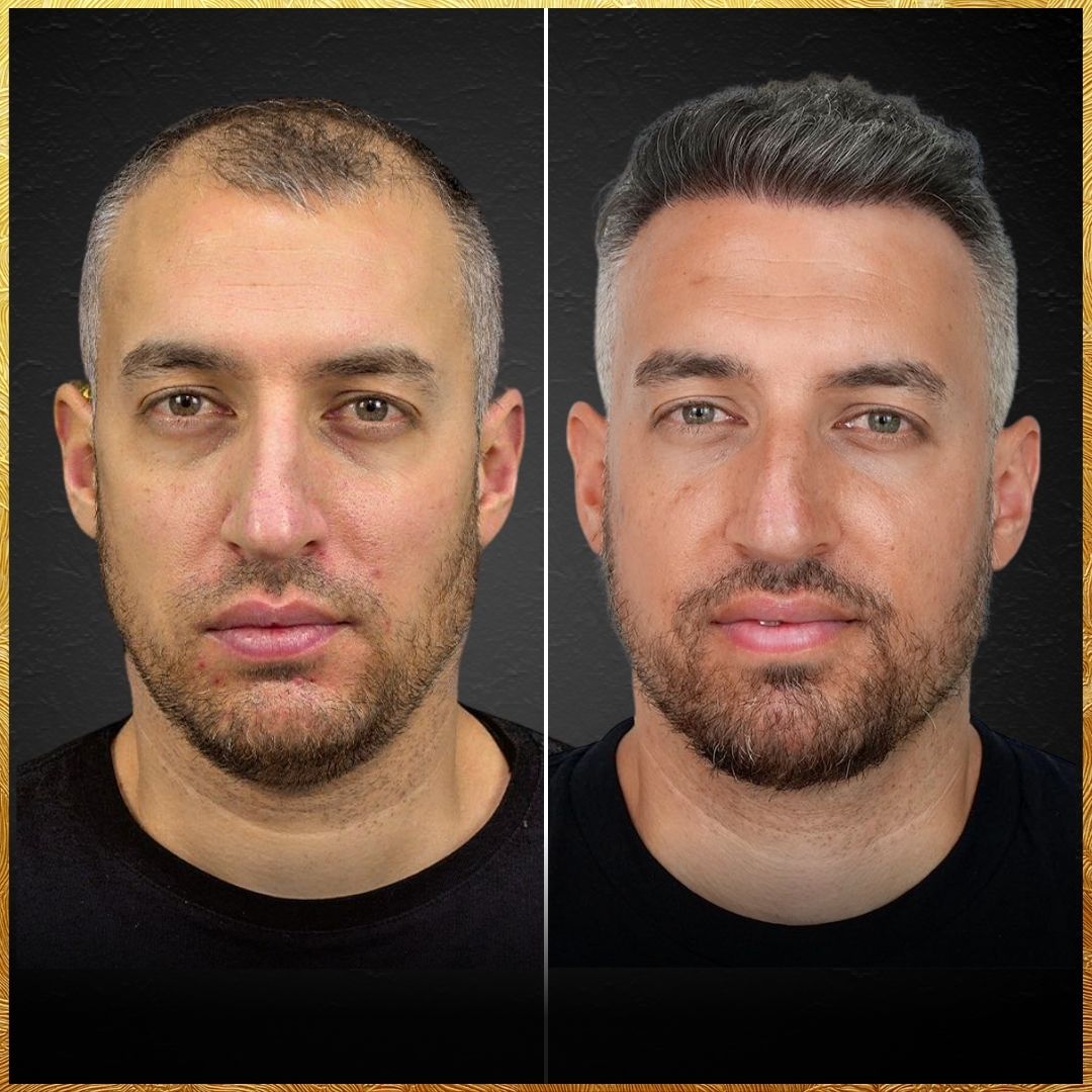 Hair Transplant Design - Dario