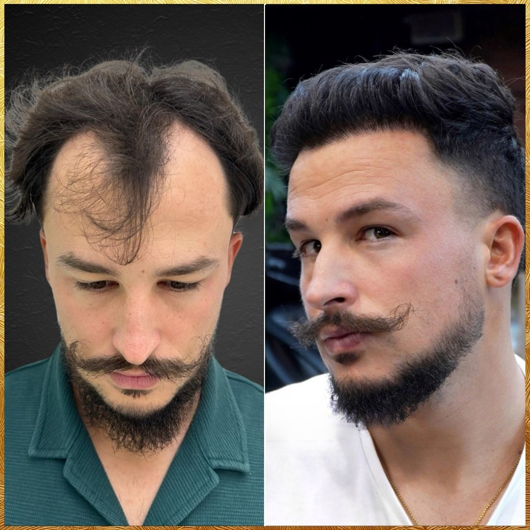 Hair Transplant Design - Jorge