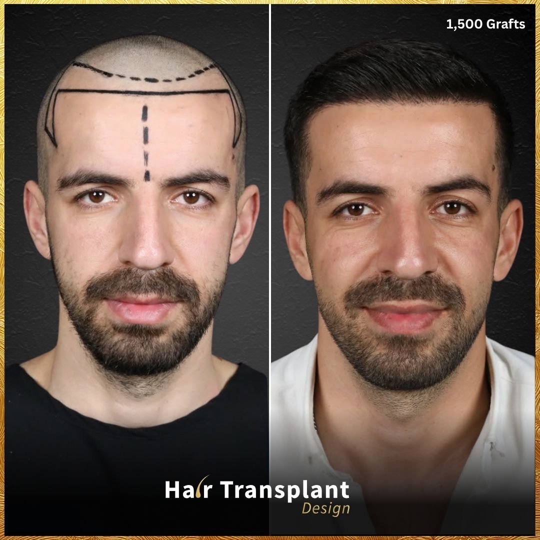 Hair Transplant Design - Mateo