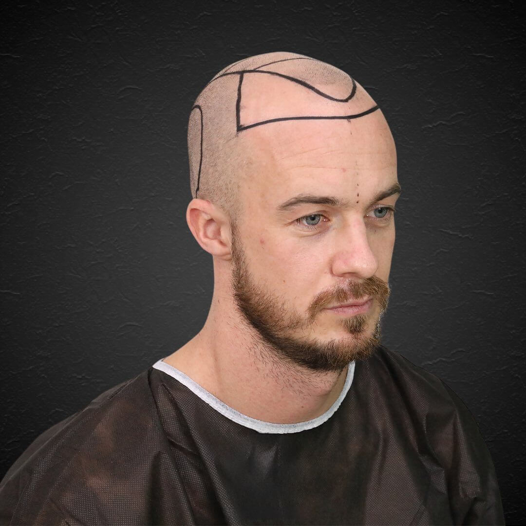 Alain - Hair Transplant Design Before 2