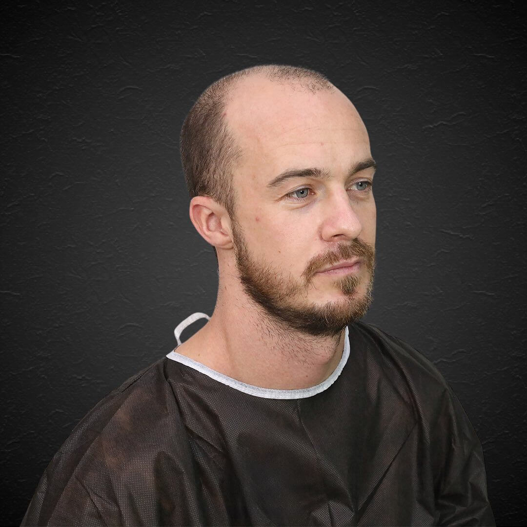 Alain - Hair Transplant Design Before