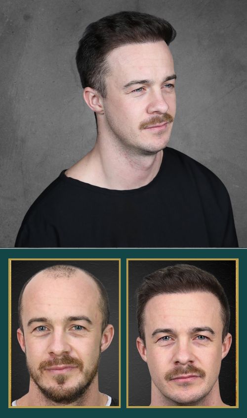 Hair Transplant Design in Tampa - Banner Mobile 2