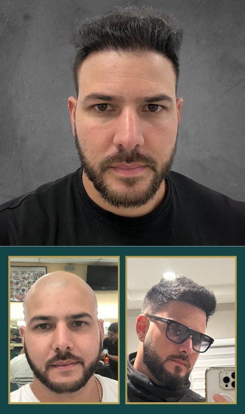 Hair Transplant Design in Tampa - Banner Mobile 4