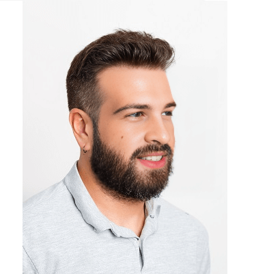 Jorge Hair Transplant Before and after 2
