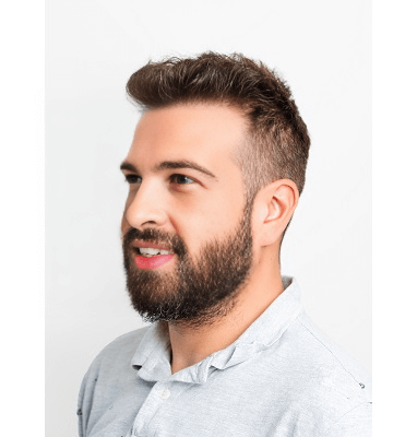 Jorge Hair Transplant Before and after 3