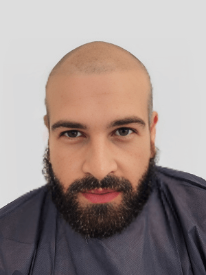 Jorge Hair Transplant Before and after 4