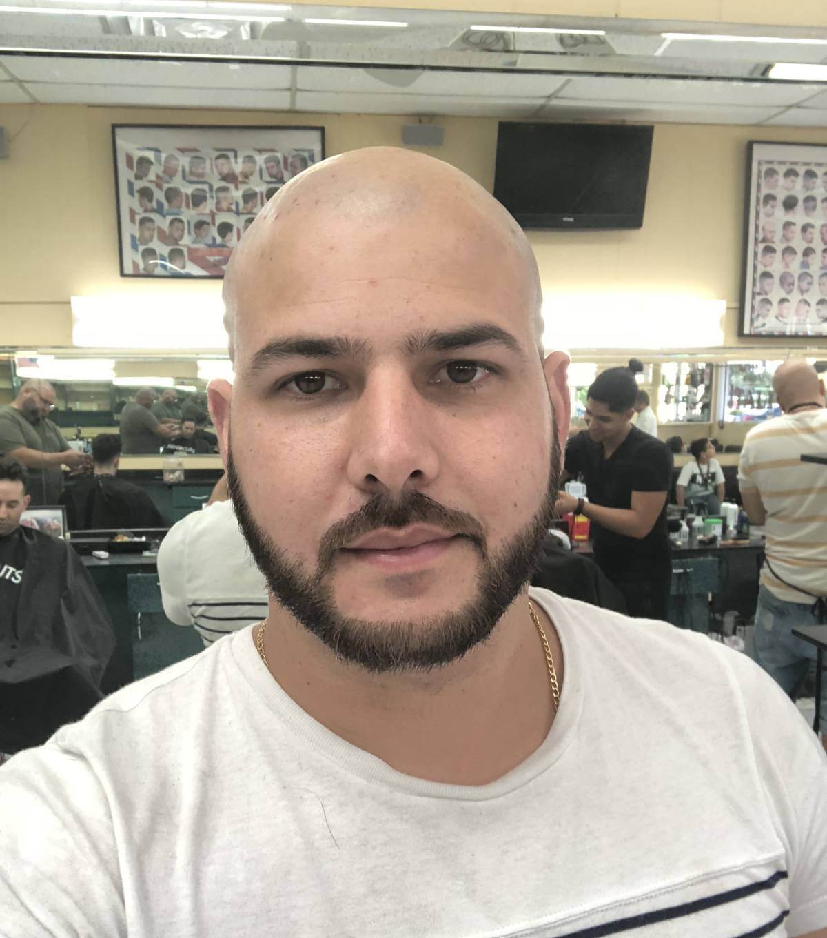 Raul Hair Transplant Antes