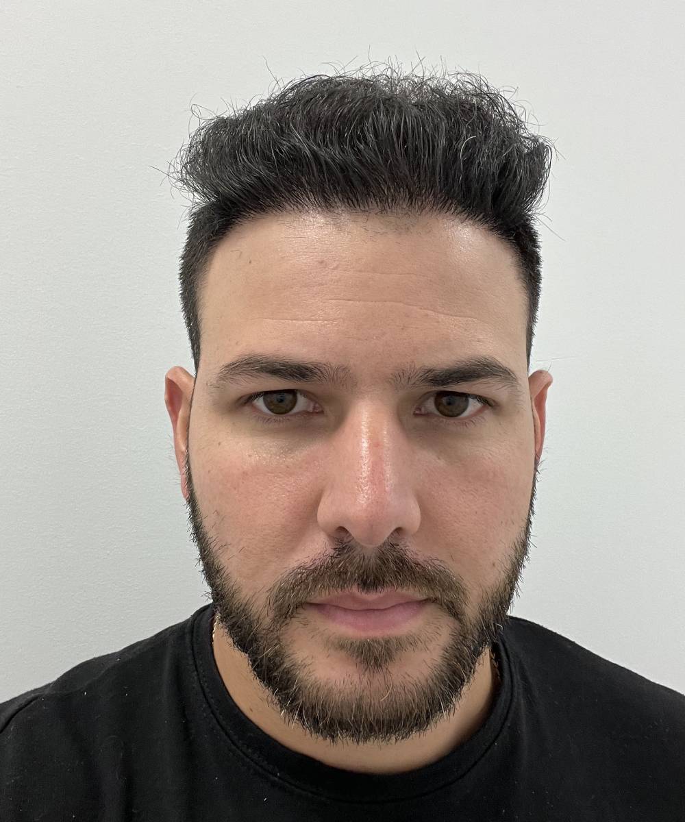 Raul Hair Transplant After 1