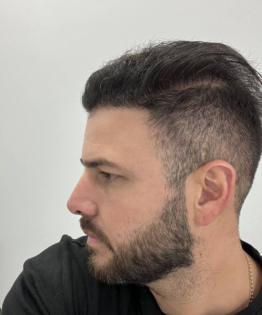 Raul Hair Transplant After 2