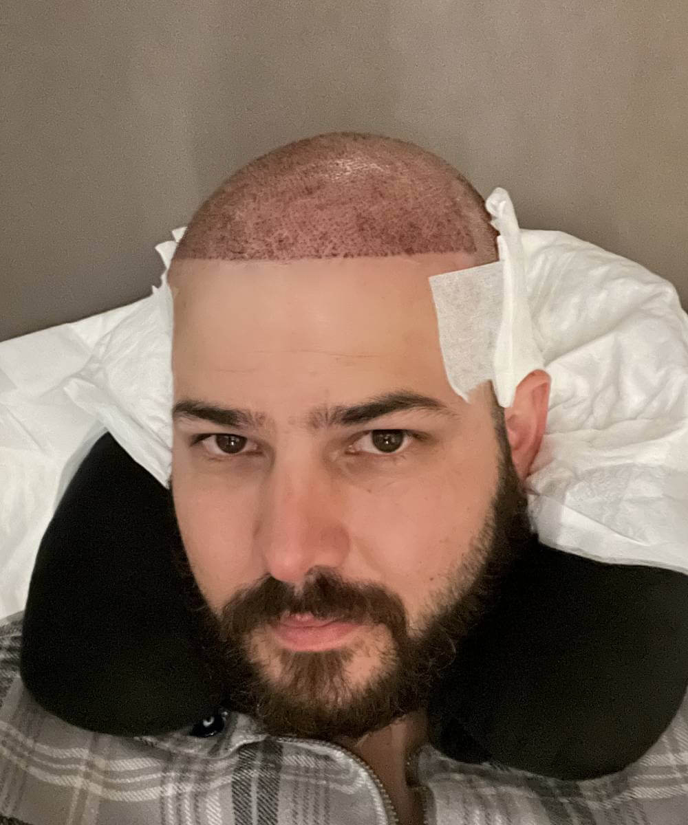 Raul Hair Transplant Design