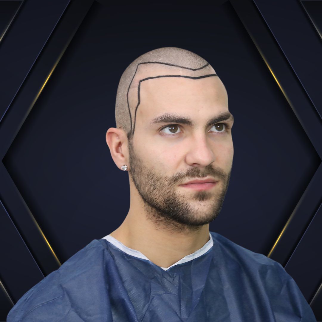 Claudio - Hair Transplant Design Before and After 1