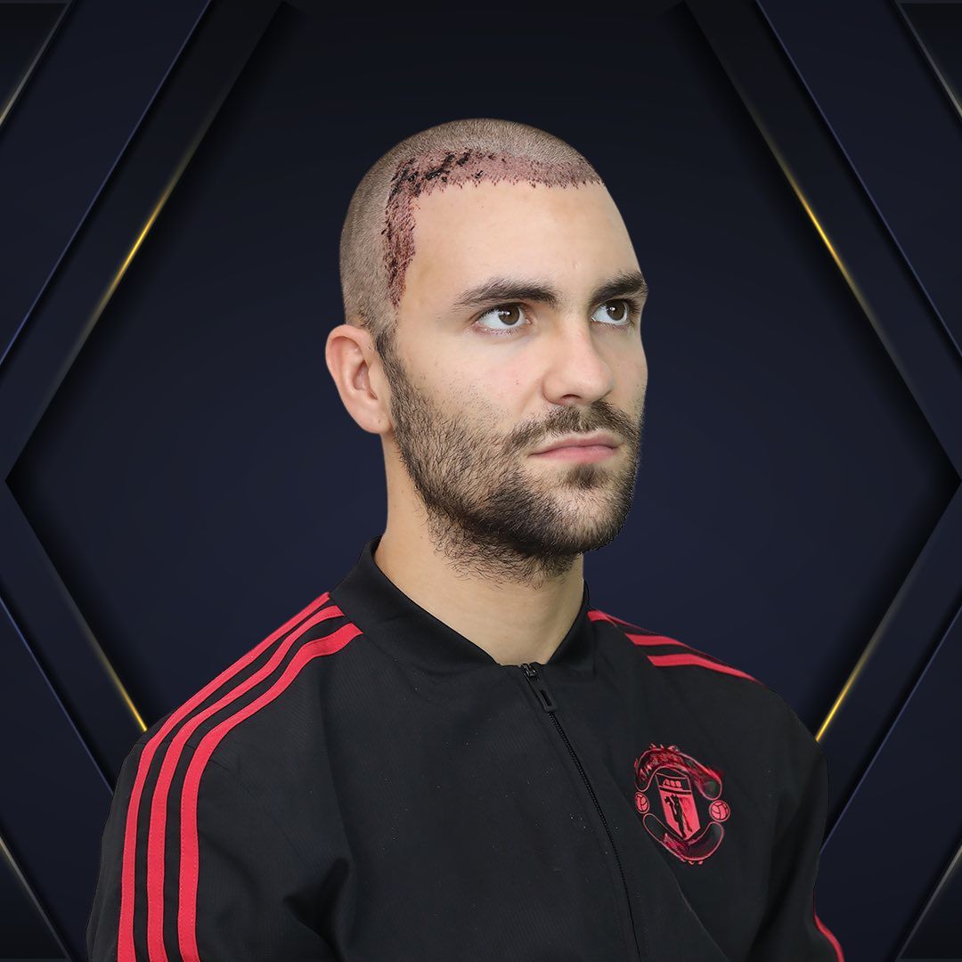 Claudio - Hair Transplant Design Before and After 2