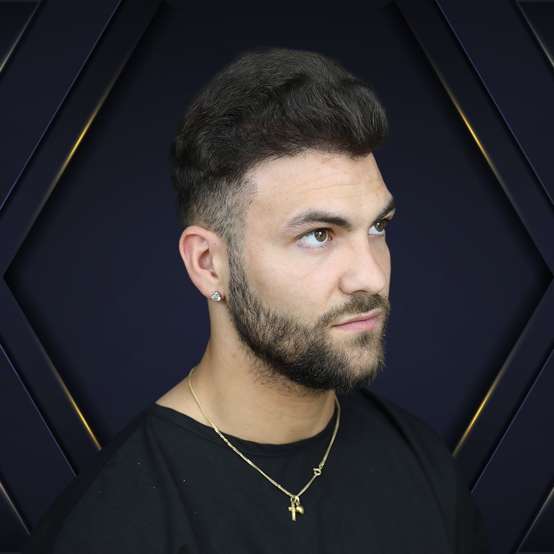 Claudio - Hair Transplant Design Before and After 3
