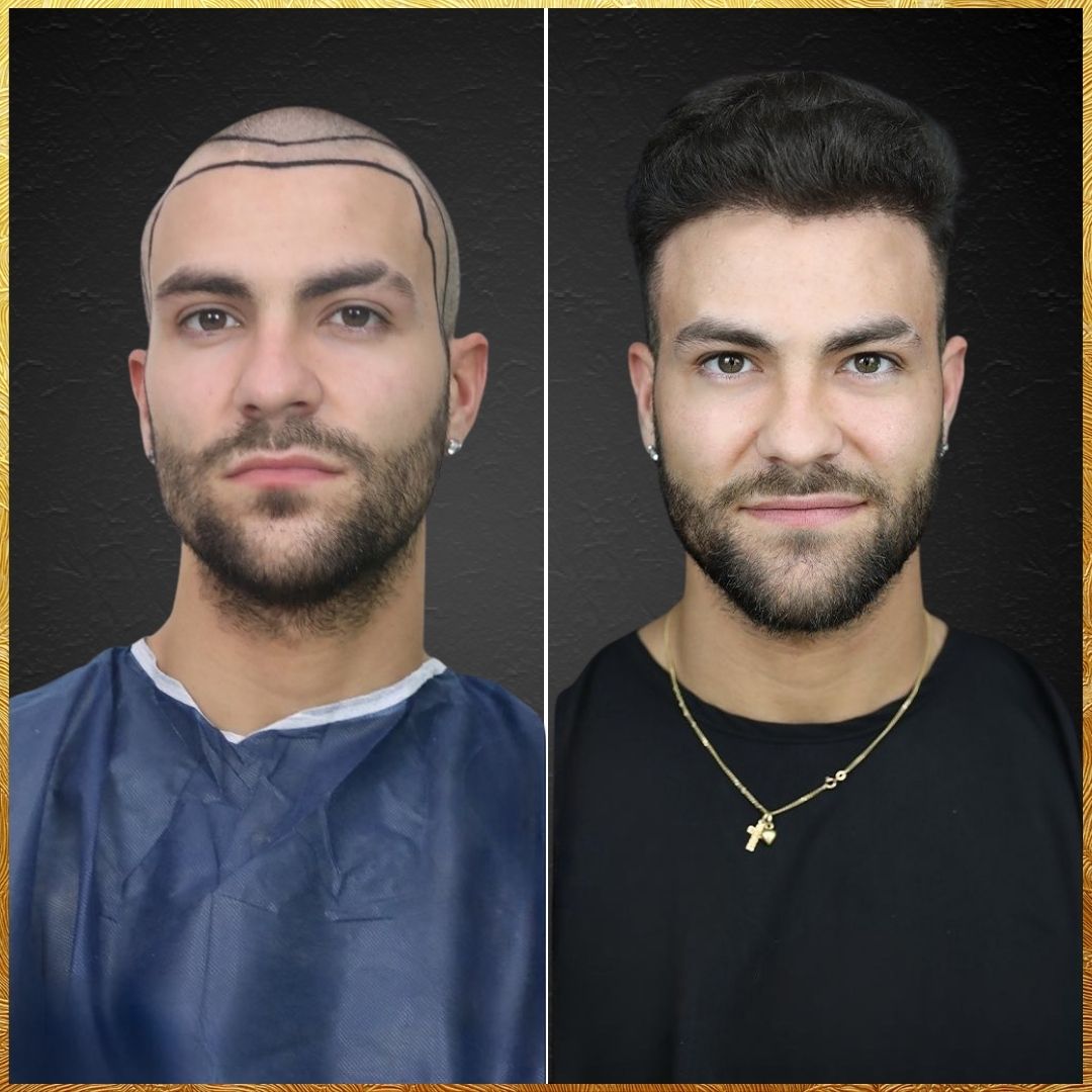 Claudio - Hair Transplant Design Before and After