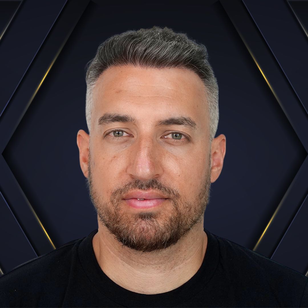 Dario - Hair Transplant Design Before and After 4500 Foliculos 1