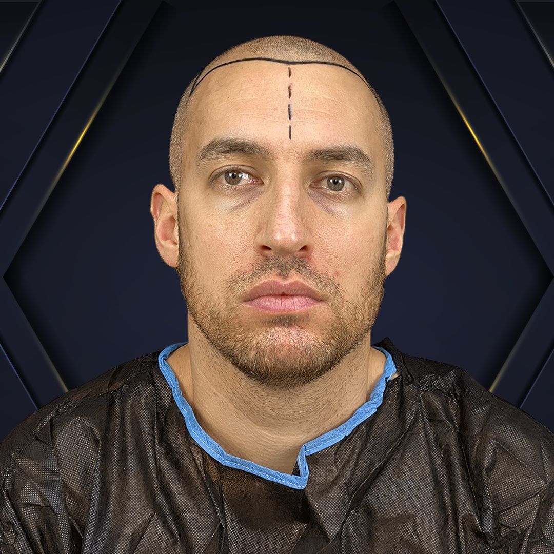 Dario - Hair Transplant Design Before and After 4500 Foliculos 2