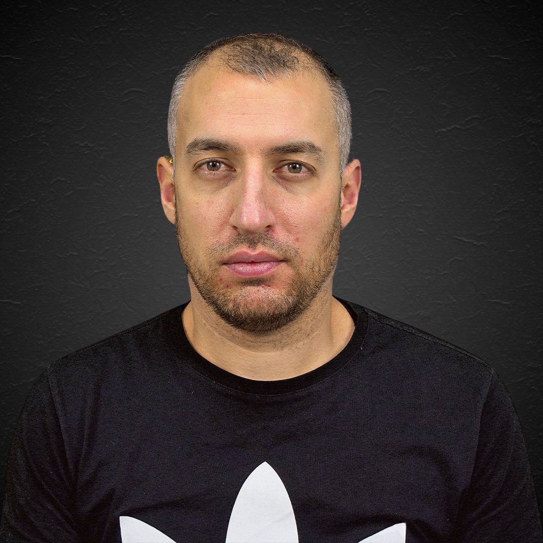 Dario - Hair Transplant Design Before and After 4500 Foliculos