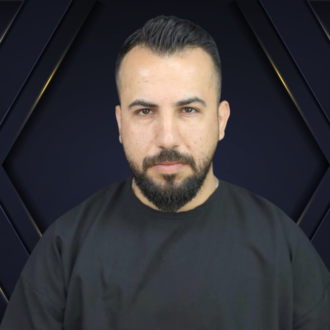 Fabio - Hair transplant Densign - Before and After 2