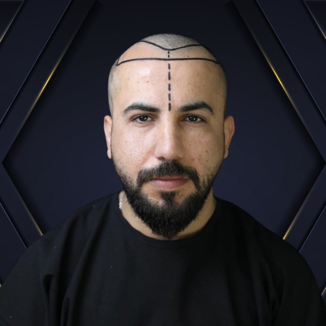 Fabio - Hair transplant Densign - Before and After 3