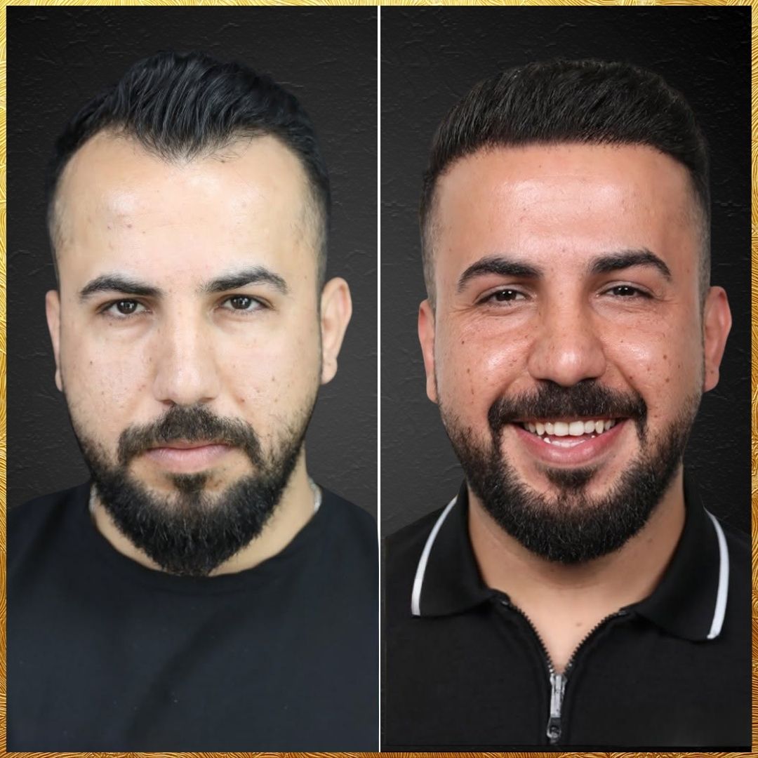 Fabio - Hair transplant Densign - Before and After