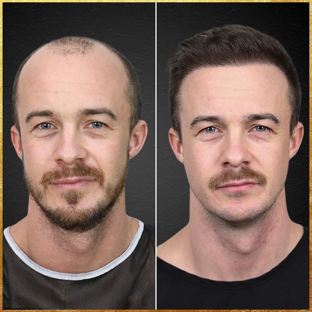 Hair-Transplant-Design-Carlos