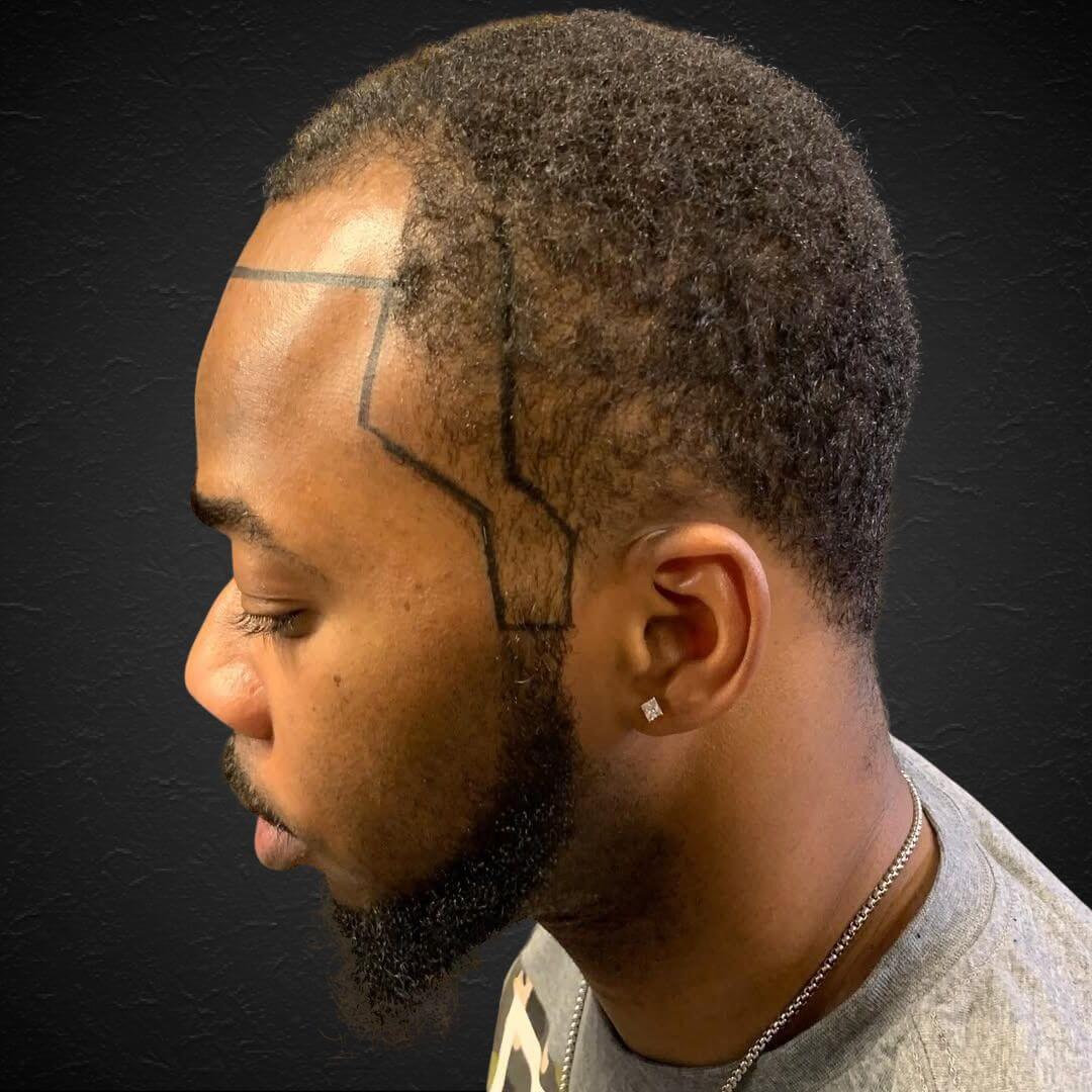 Hair Transplant Design in Tampa - Before and after