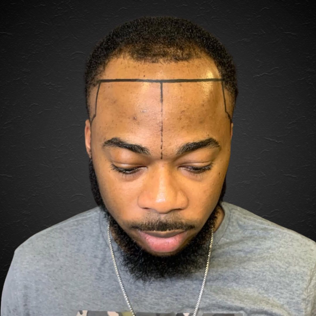 Hair Transplant Design in Tampa - Before and after
