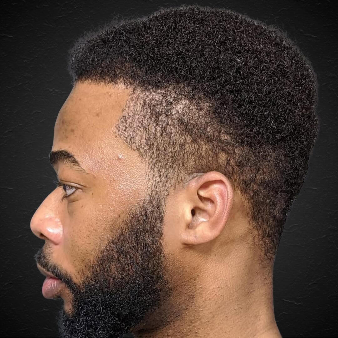 Hair Transplant Design in Tampa - Before and after