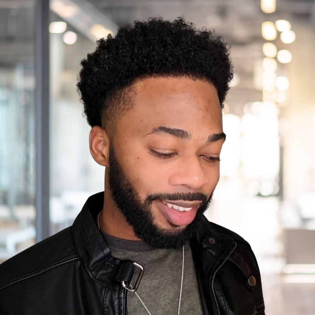 Hair Transplant Design in Tampa - Before and after